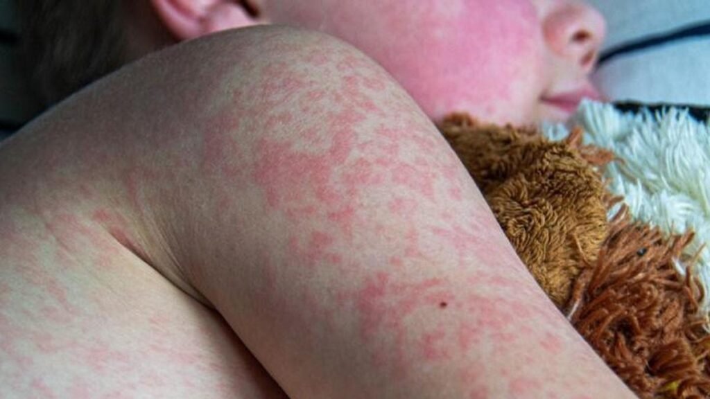 El sarampión se expande por los 32 estados de México; Puebla registra un nuevo caso.